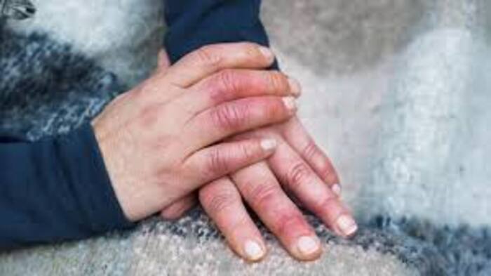 Why do fingers and toes swell in winter