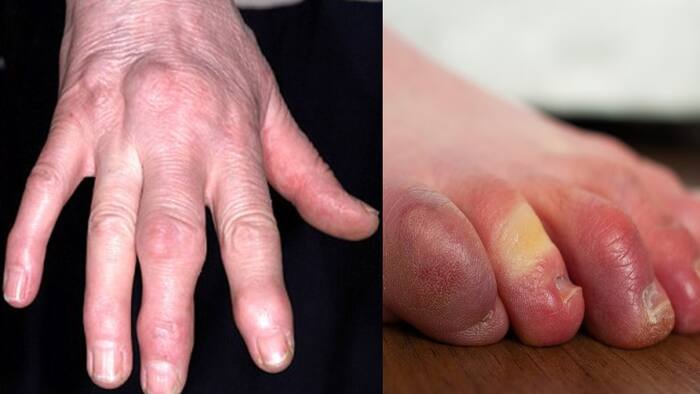 Why do fingers and toes swell in winter