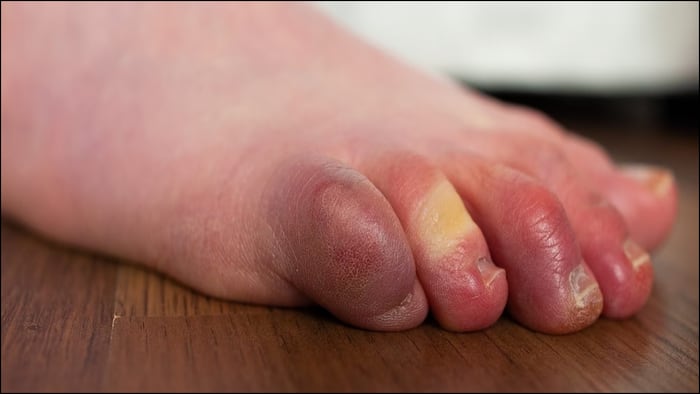 Why do fingers and toes swell in winter