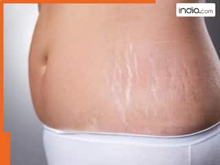 वजन कम करने पर क्यों पड़ जाते हैं स्ट्रेच मार्क्स? जानें घरेलू उपाय और कैसे करें बचाव