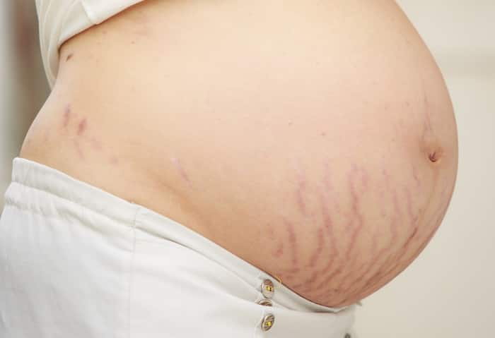 Stretch marks Remedies