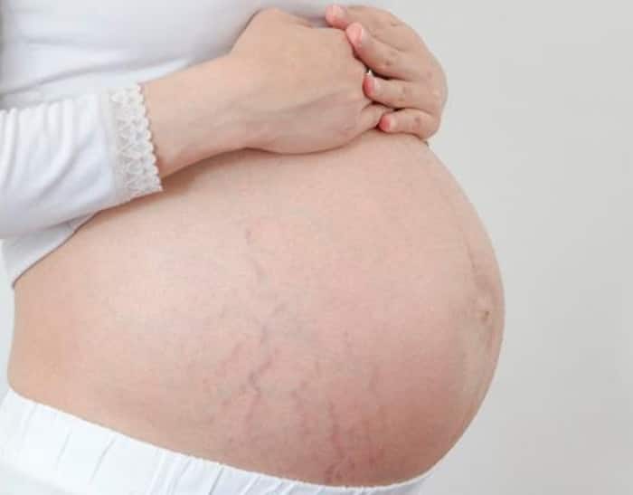 Stretch marks Remedies