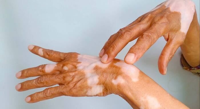 Does eating beetroot with gourd really cause Vitiligo