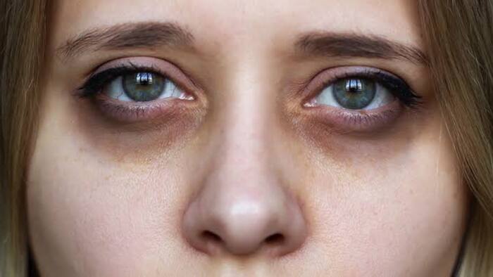 Dark Circles Remedies